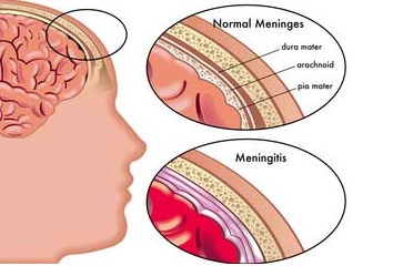 brain-meninges-meningitis